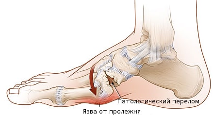 Костная форма диабетической стопы