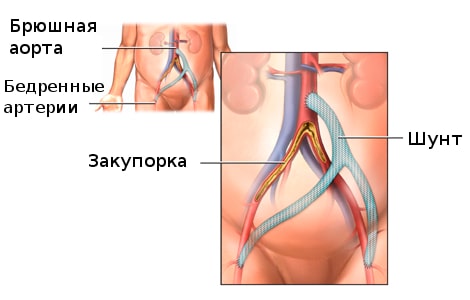 Шунтирование аорты - "штаны"