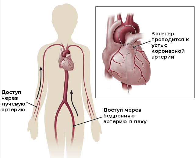 Доступы для коронарографии